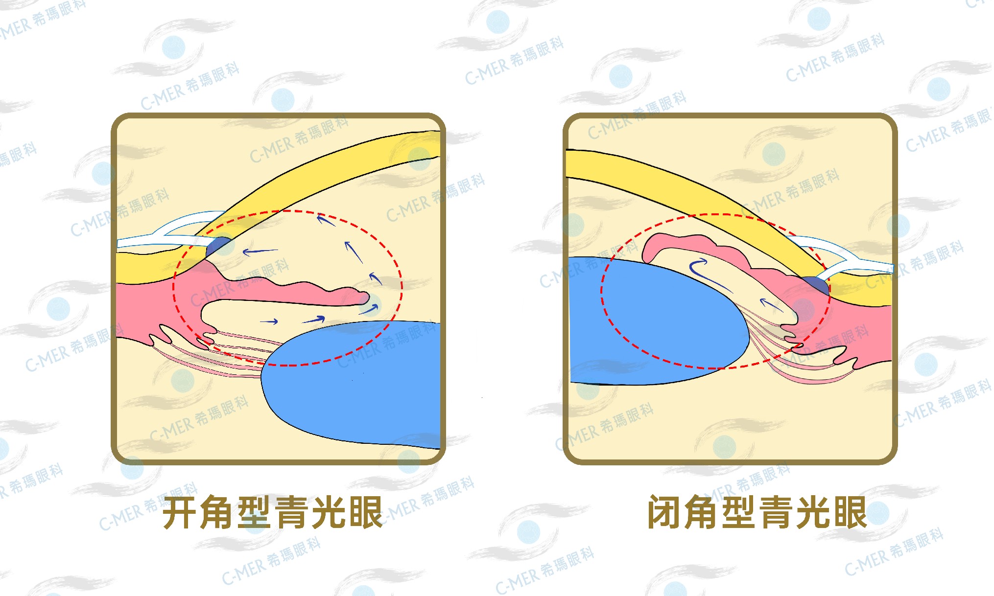 開角型青光眼及閉角型青光眼