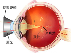 惠州眼科醫院：“蚊子”飛進眼睛里會瞎？