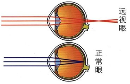 遠視,怎么,矯正,三種,方式,如果,看見,一個人,