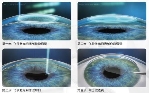 近視,近視手術,近視矯正,全飛秒,icl