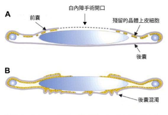 白內障手術