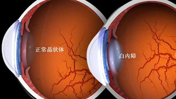 白內障,青光眼,白內障手術,惠州希瑪眼科醫(yī)院