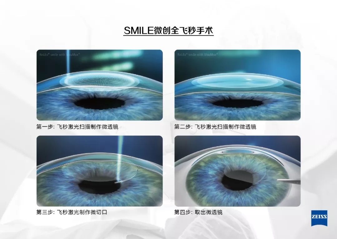 近視手術,激光矯正,晶體植入式,惠州希瑪眼科醫