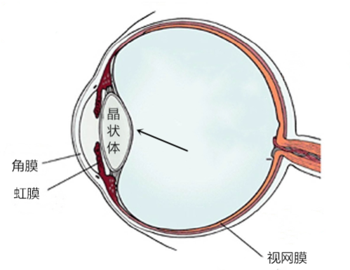 白內障,視力模糊,色覺異常,老花眼,單眼復視,惠州