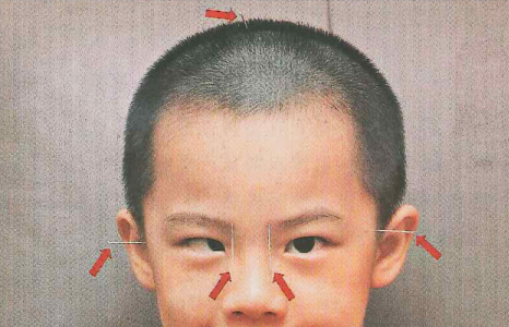 小兒斜視,小兒弱視,兒童眼科疾病,惠州希瑪眼科