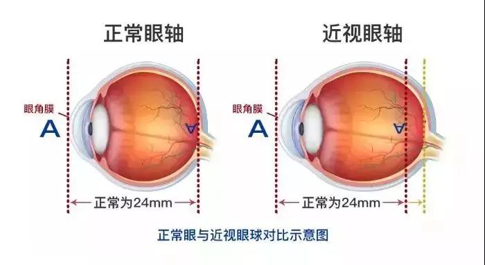 近視,小兒眼病,惠州希瑪眼科醫院
