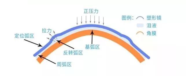 青少年近視,兒童近視,OK鏡,惠州希瑪眼科醫院