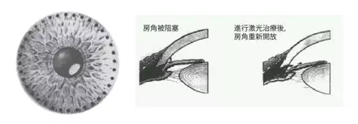 干眼癥,急性青光眼,眼中風,惠州?，斞劭漆t院