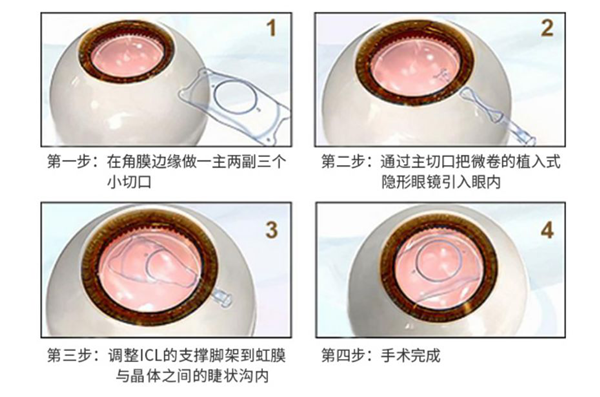 近視,治療近視，近視手術，惠州希瑪眼科醫院