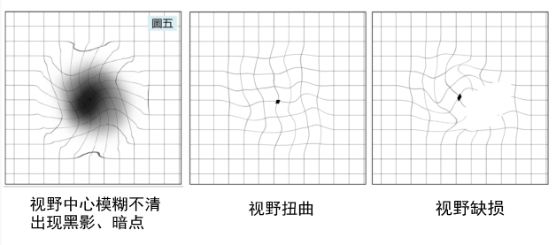 高度近視,屈光,近視,惠州希瑪眼科