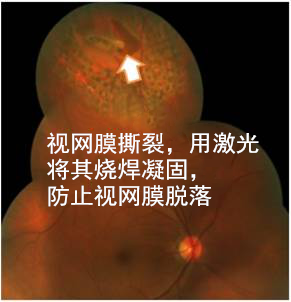 飛蚊,病癥,玻璃體,視網膜,惠州希瑪眼科醫院
