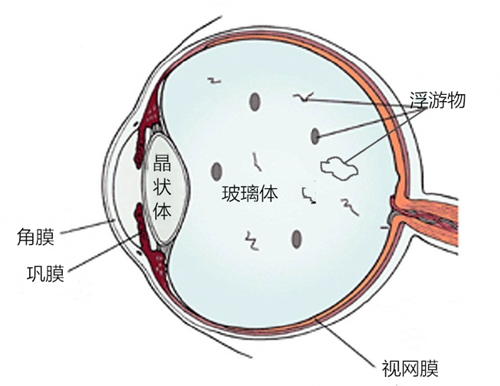 飛蚊,病癥,玻璃體,視網膜,惠州希瑪眼科醫院