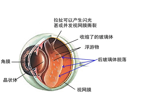 飛蚊,病癥,玻璃體,視網膜,惠州希瑪眼科醫院
