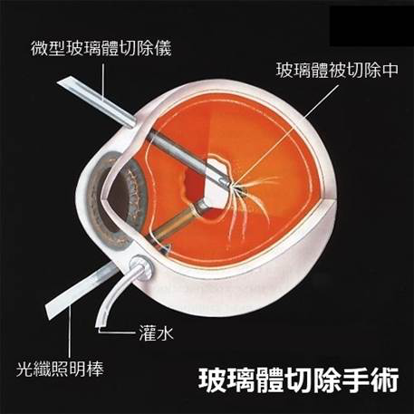 視網膜脫落,高度近視,近視手術,惠州希瑪林順潮
