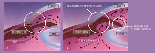 白內(nèi)障,黃斑轉(zhuǎn)性,青光眼,惠州希瑪眼科醫(yī)院