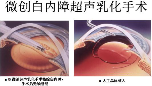 白內障,白內障的癥狀,白內障手術,惠州希瑪眼科
