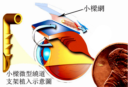 青光眼,失明性眼睛疾病,惠州希瑪眼科