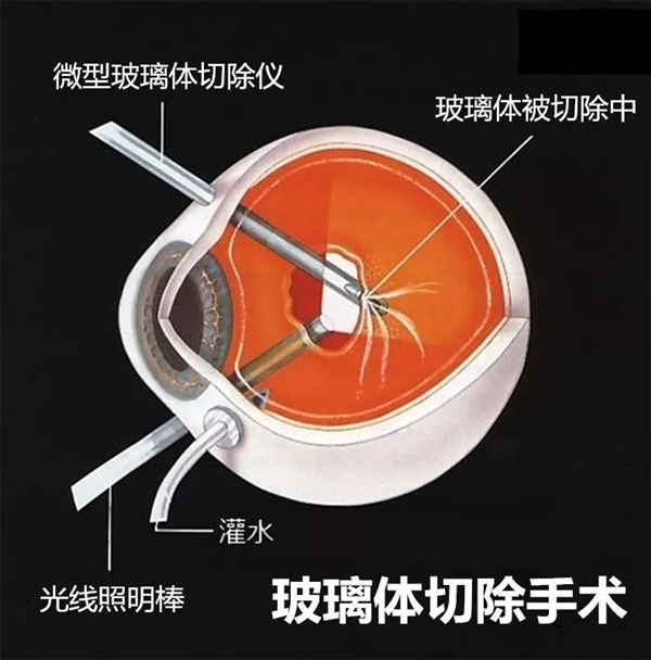 視網膜病變,糖尿病患者,網膜病變,惠州希瑪眼科
