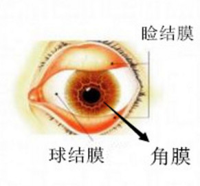角膜炎,角膜鱗狀,角膜穿孔,惠州希瑪眼科醫院