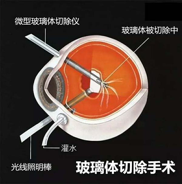 飛蚊癥,玻璃體渾濁,視網(wǎng)膜脫落,惠州希瑪眼科醫(yī)