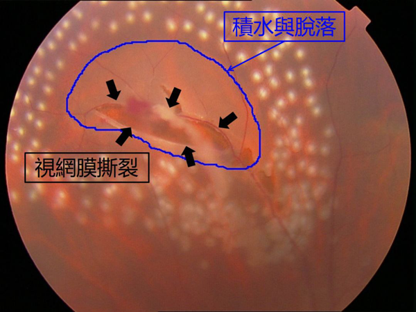 飛蚊癥,玻璃體渾濁,視網(wǎng)膜脫落,惠州希瑪眼科醫(yī)