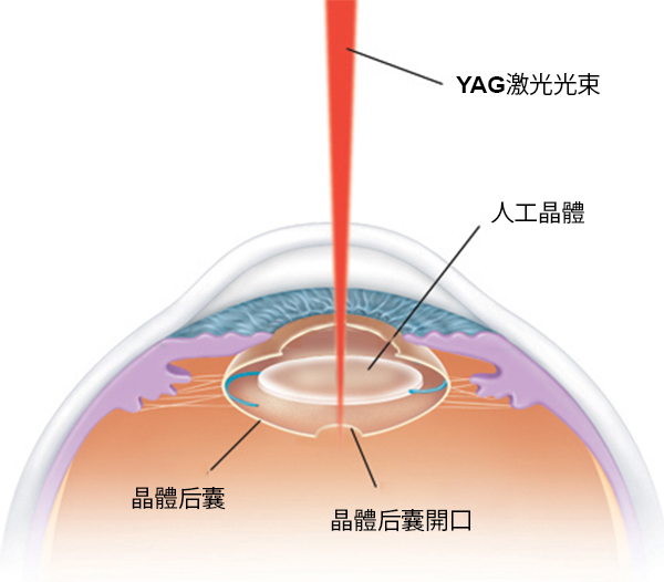 白內障,白內障手術,惠州希瑪眼科醫院