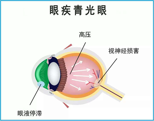 青光眼,惠州治療青光眼,惠州?，斞劭漆t院