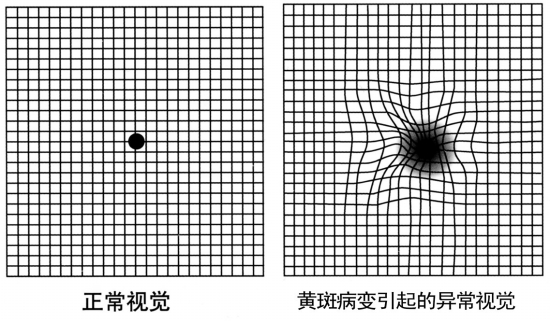 黃斑變性,黃斑變性,老年黃斑變性,惠州希瑪眼科