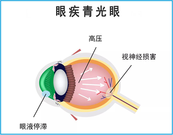 青光眼,繼發型青光眼,惠州希瑪眼科醫院