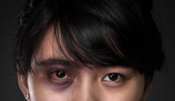 眼外傷,惠州希瑪眼科醫院