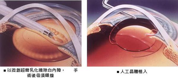 白內(nèi)障,白內(nèi)障手術(shù),白內(nèi)障治療,惠州希瑪眼科醫(yī)