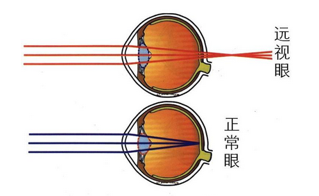 散光,散光測試,惠州希瑪眼科醫院