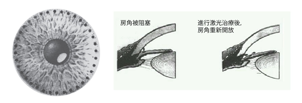 白內障,白內障手術,惠州希瑪眼科醫院