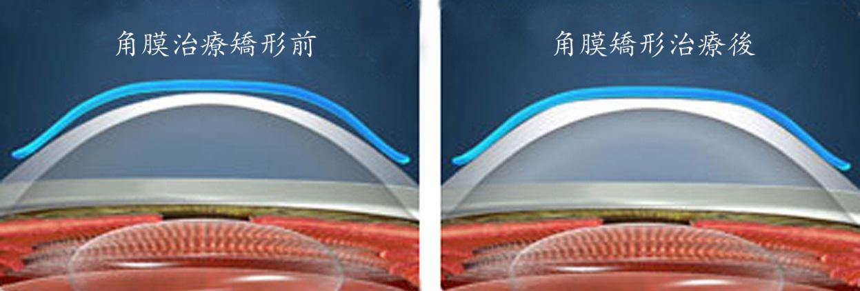 OK鏡,惠州OK鏡,惠州希瑪眼科醫院