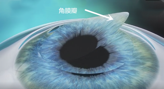 近視,近視手術,惠州希瑪眼科醫院