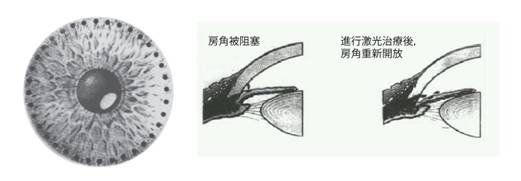 青光眼,急性青光眼,治療青光眼,惠州希瑪眼科醫(yī)院