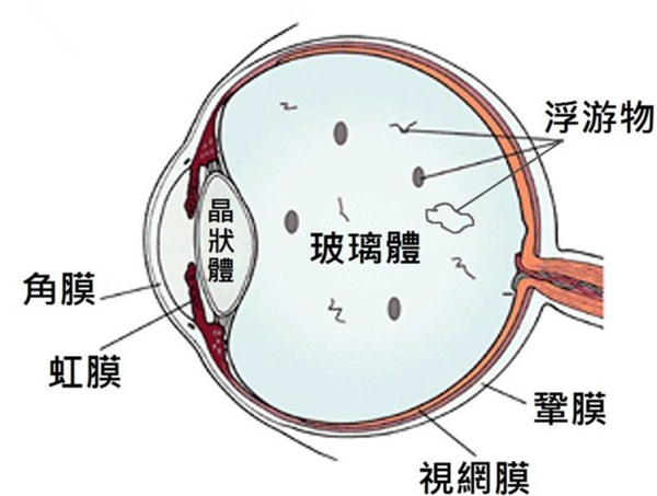 飛蚊癥,玻璃體渾濁,飛蚊癥治療,惠州希瑪眼科醫(yī)院