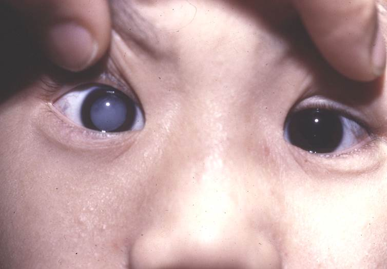 白內(nèi)障,白內(nèi)障醫(yī)院,惠州希瑪眼科醫(yī)院