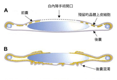 白內障,白內障手術,惠州希瑪眼科醫院