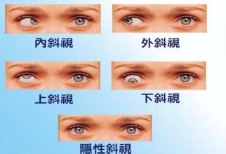 弱視,小兒弱視,治療弱視,惠州希瑪眼科醫(yī)院