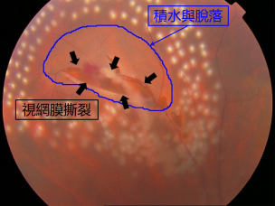 視網膜脫落,視網膜撕裂,近視手術,惠州希瑪林順潮眼科醫院