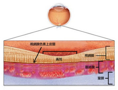 眼中漿嚴重嗎？可以治好嗎