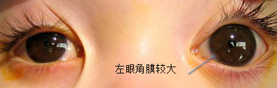 青光眼,先天性青光眼,青光眼治療,惠州希瑪林順潮眼科醫院