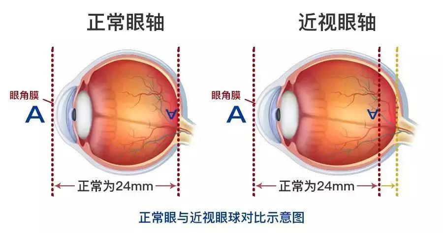 近視,惠州治療近視哪家好,惠州希瑪林順潮眼科醫院