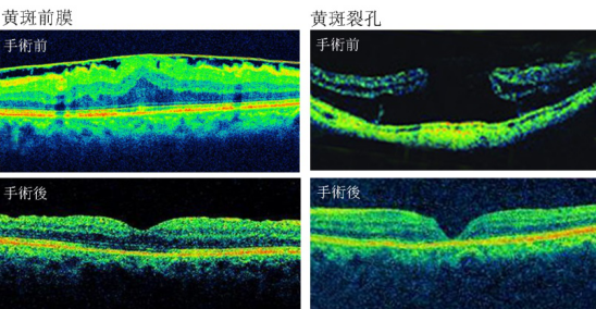 近視,惠州治療近視哪家好,惠州希瑪林順潮眼科醫院