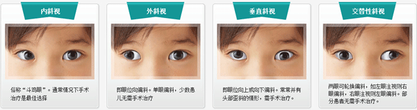 小兒斜視,小兒弱視,治療斜視,惠州希瑪林順潮眼科醫院