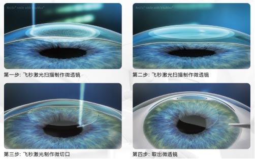 飛秒激光和準分子激光的區別